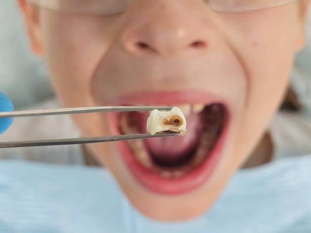Best Emergency Dentist for Lost Fillings or Crowns in Cedar Rapids, IA